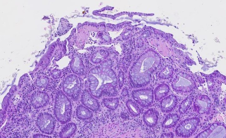 DraEosina's tweet image. Definitely the best example of ☢️radiation colitis☢️ I've ever seen.
Angiectatic vessels are so prominent; they even show superficial thrombi.
#GiPath #Pathology