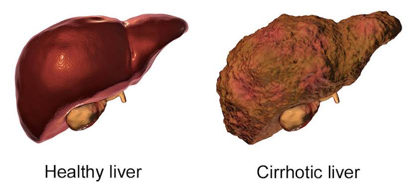 Cirrhosis Of The Liver 

 #Worldliverday

   Let's learn 👇