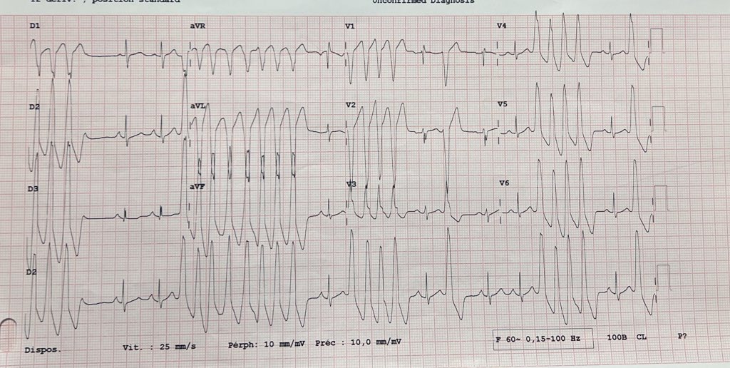VT with very similar morphology in two different patients with palpitations the same day in the #EmergencyRoom 
Is ventricular arrhythmia contagious 😷? No known cardiac pathology. Normal echocardiography. #Epeeps #SOO @ALFIEEP1 @Hapa_EP @WaintraubX @ArashArya_EP
