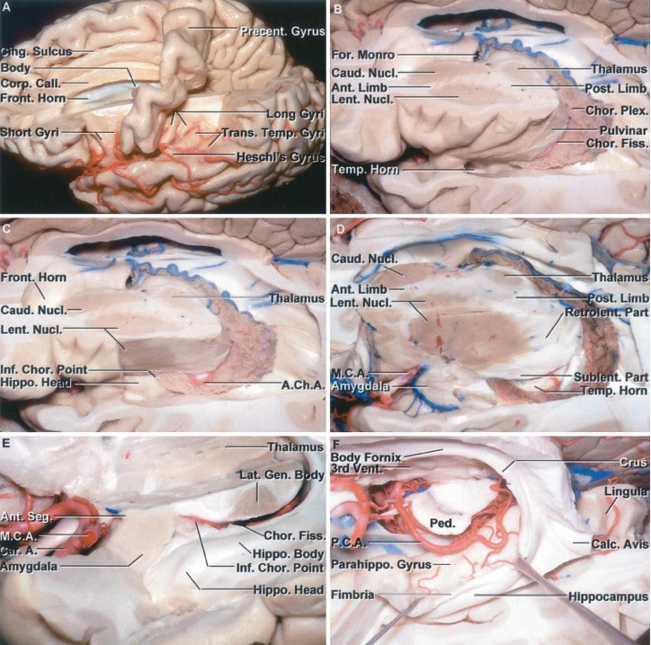 The operative anatomy of the thalamus is highly complex. How many anatomical regions can it be divided into based on operative approaches? Which region contains the lateral nuclei?

 #MedTwitter #Neurosurgery #NSGY #surgery