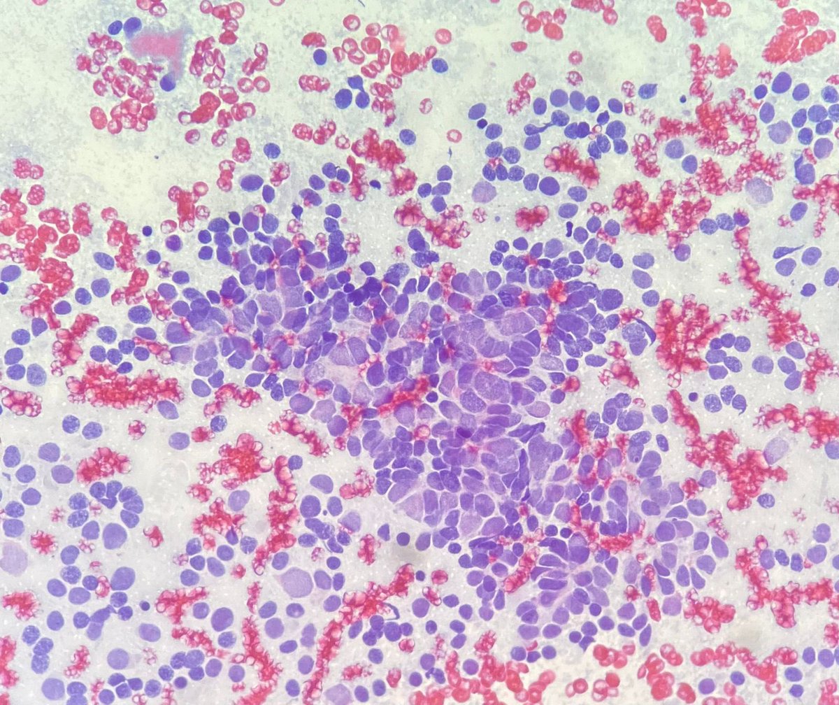 2 year old with a flank mass. A tumour of 3’s-3 histological components, 3 associated syndromes. Read about it below 👇 #PediPath #Pathtwitter #Medtwitter #Cytopath