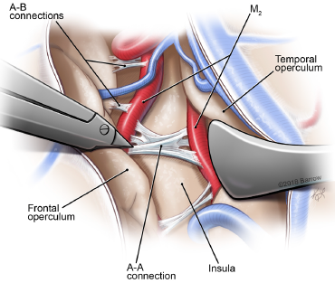 Watch the Seven Series video showing this pterional craniotomy, Sylvian fissure dissection, and resection of temporal Sylvian arteriovenous malformation, on our website @BarrowNeuro by clicking on this link…Bar.rw/7series