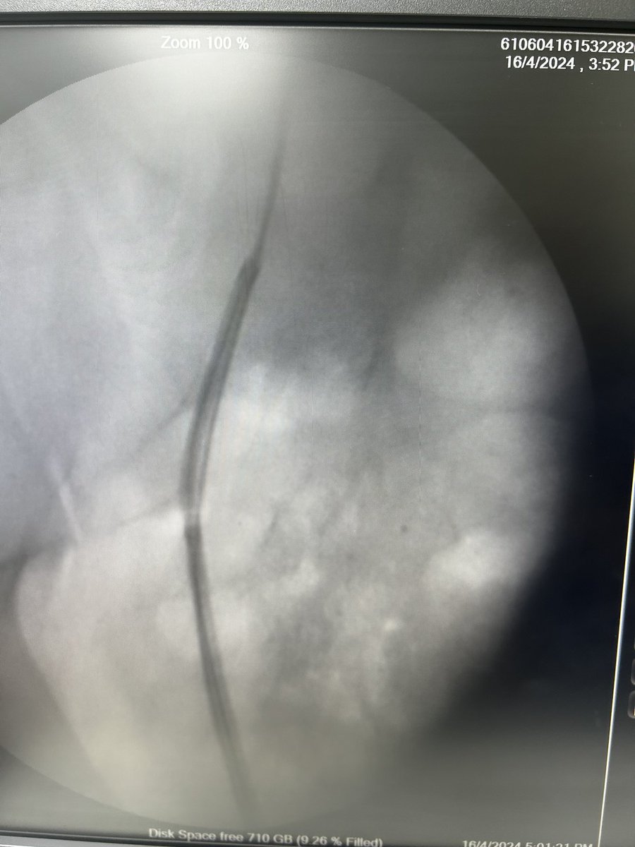 After left hip surgery. Cannot abduct patient left leg in lithotomy position. Semirigid URS could not pass to right ureter due to difficult position. Flexible ureteroscopy saved the case.