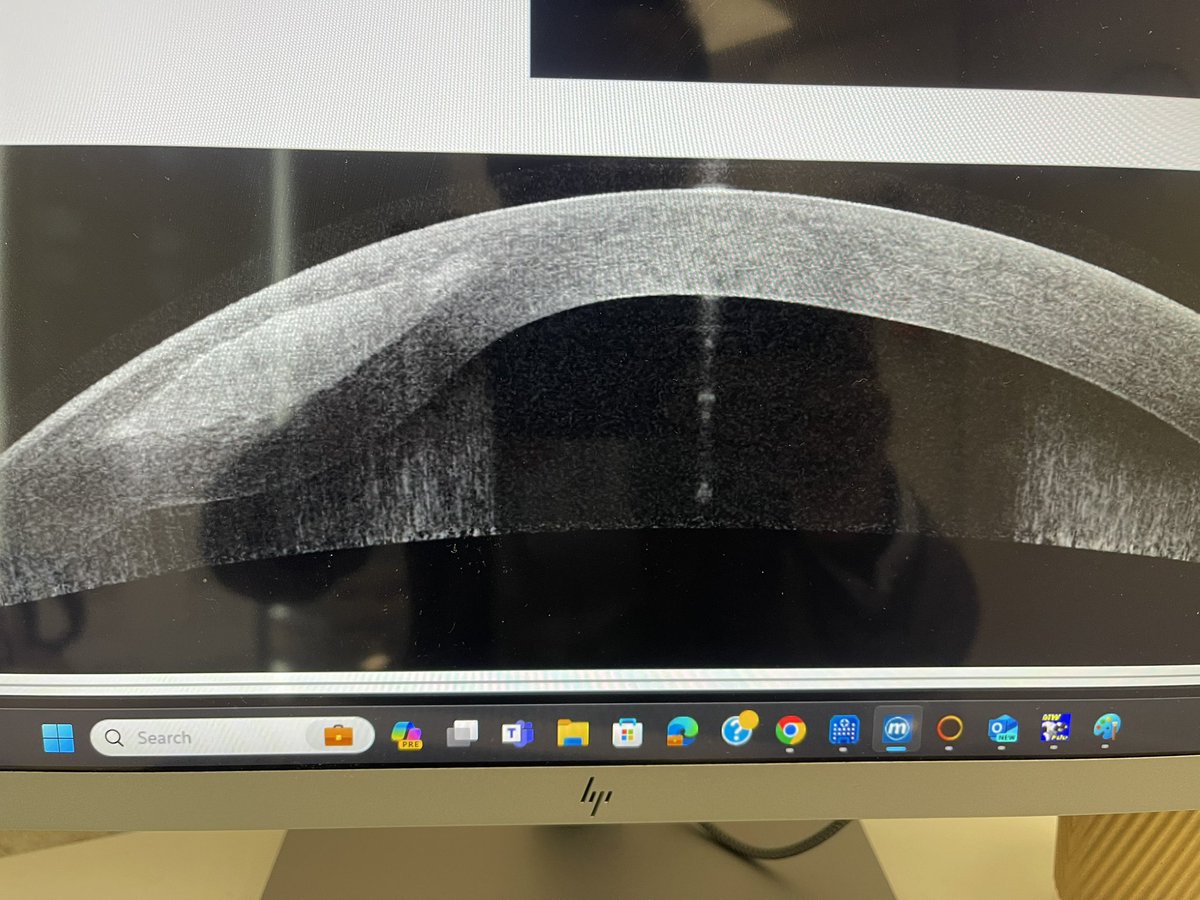 CAIRS - corneal allogeneic Intrastromal ring segments, a natural tissue addition technique is a game changer in the management of #keratoconus patients with poor vision. Can be used before or after cross linking and can avoid need for transplants <a href="/oclvision/">OCL Vision</a>