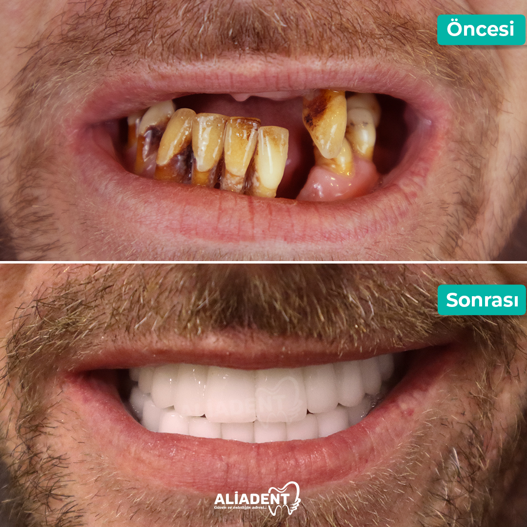 Stunning transformations at Aliadent! 😁 

Check our before and after photos to see the power of our professional treatments. 

Every smile is a work of art! More details at aliadent.com/en 

#zirconiumcrowns #zirconium #zirconiumteeth