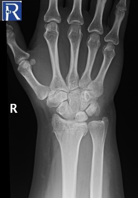 A 35-year-old female was admitted following a fall onto her outstretched hand, resulting in right wrist pain.#radiology #mskradiology #EmergencyMedicine #Emergencyradiology #radtwitter #MedTwitter #radres #orthopedic #orthotwitter #medstudenttwitter