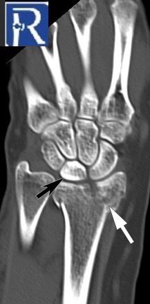 radiologybmj's tweet photo. CT imaging offers more precise visualization of both the distal radius fracture and the diffuse sclerosis of the lunate bone, with these findings being more distinct on the CT images.#radiology #radtwitter #EmergencyMedicine #MedTwitter #medstudent #radstudent https://t.co/XDgjSu1eZa