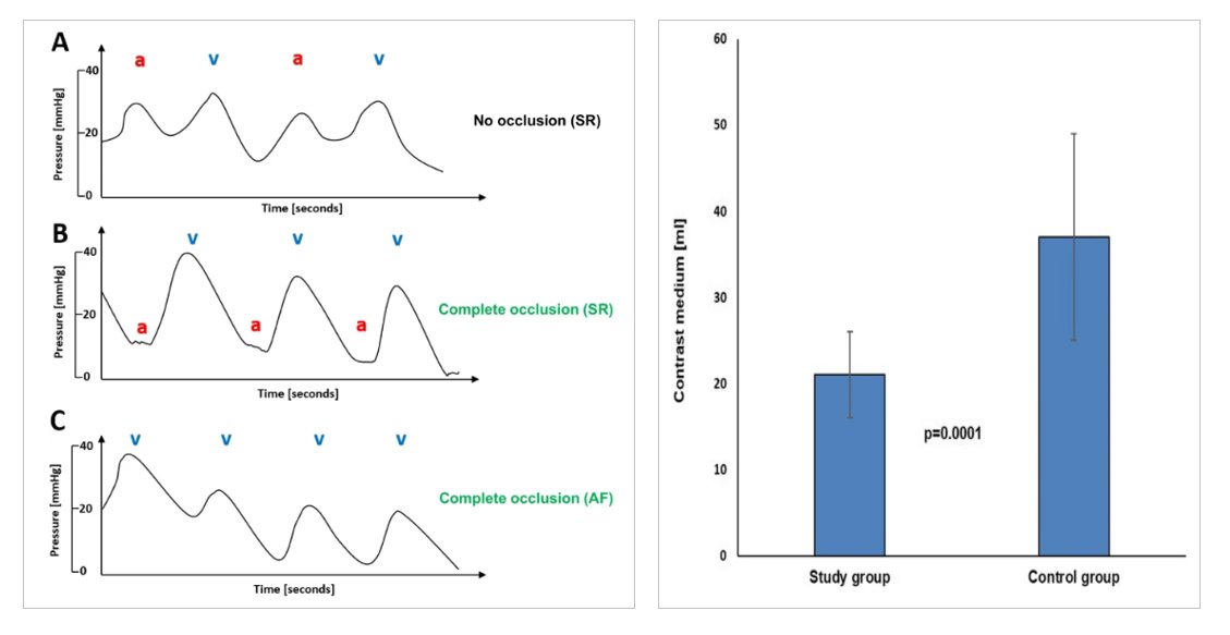 🚨New #FreeRead in Article in @JICE_EP Pressure Waveform Analysis for Occlusion Assessment Significantly Reduces Contrast Medium Use in Cryoballoon PVI 🧐📖 rdcu.be/dFeqt by @VanessaSciacca_, Thomas Fink, Stephan Winnik, @melhamriti, Denise Guckel,