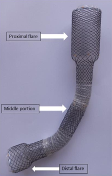 The Luso-Cor esophageal stent effectively manages fistulas after sleeve gastrectomy with low risk of migration ow.ly/UV5P50RkbJo @VinayChandraMD