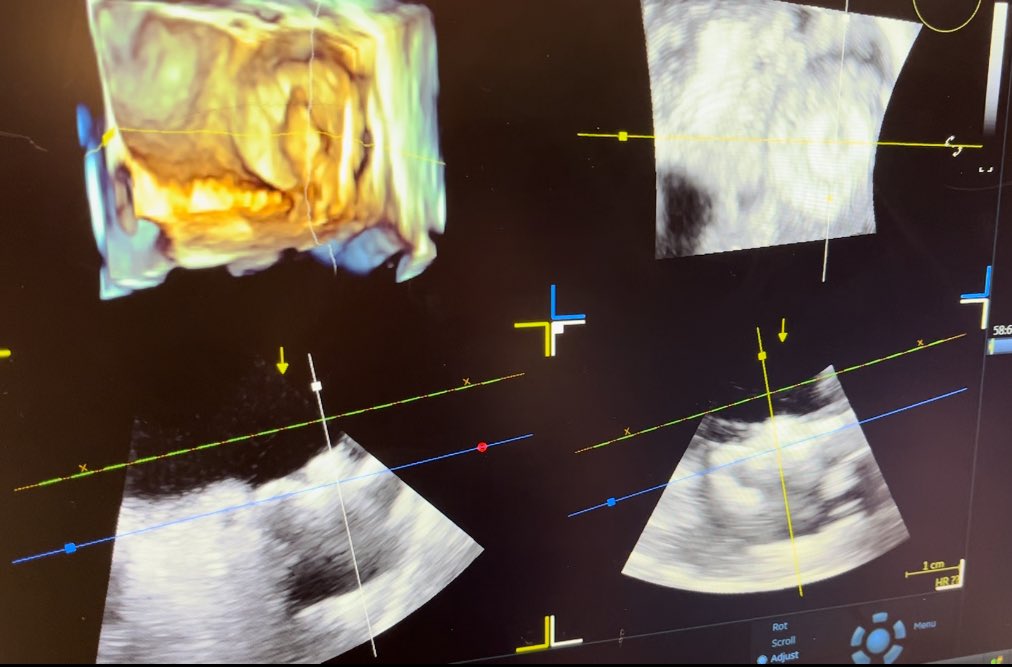 Is conscious sedation the next frontier for #LAAO? With imaging like 4D ICE and the mini TEE probe @DrTomWaggoner analyzed in our WATCHMAN FLX discussion, has your team moved towards conscious sedation? @DrJayMohan @TheNarulaSeries @pkothapalliMD @dngibson2 @Almanfi_Cardio