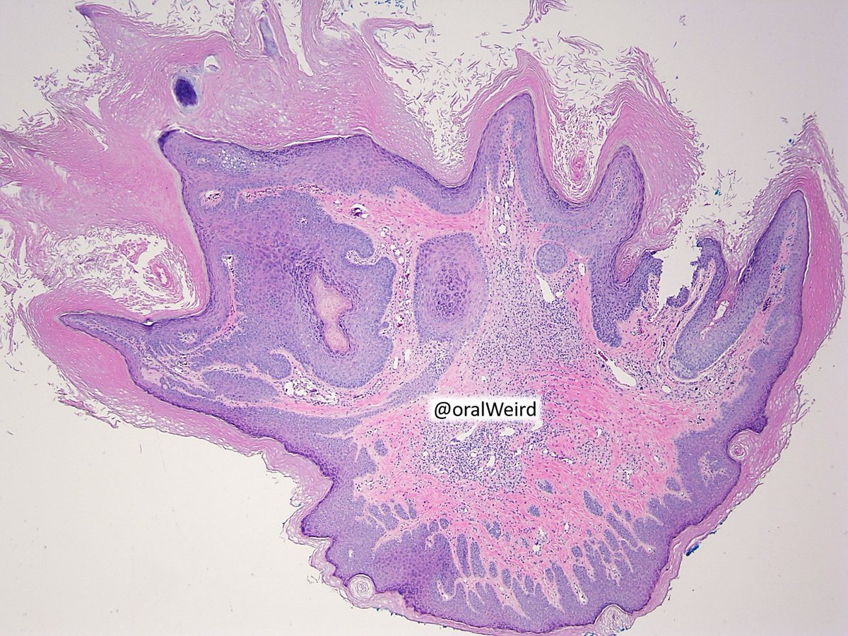 One📸one diagnosis🤓 *👃lesion*
#pathology #pathologist #headandneck #PathTwitter #picoftheday #oralpath #ENT #ENT_Pathology #headandneckpathology #dermpath #dermtwitter