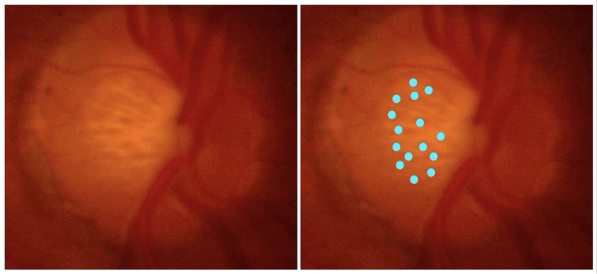 Lamina Cribrosa Pores May Help Identify Severe Glaucoma

These findings were associated with greater degrees of optic disc cupping and higher proportions of African ancestry.
reviewofoptometry.com/article/lamina…
#glaucoma #optometry