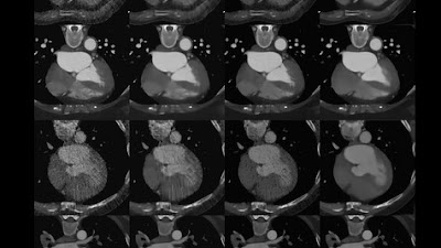 #DeepLearning-based 3D denoising of dose-modulated cardiac CTA doi.org/10.1148/ryai.2… @StanfordRad @MarinaCodari @Mastrodicasa_MD #SyntheticData #heart #MachineLearning