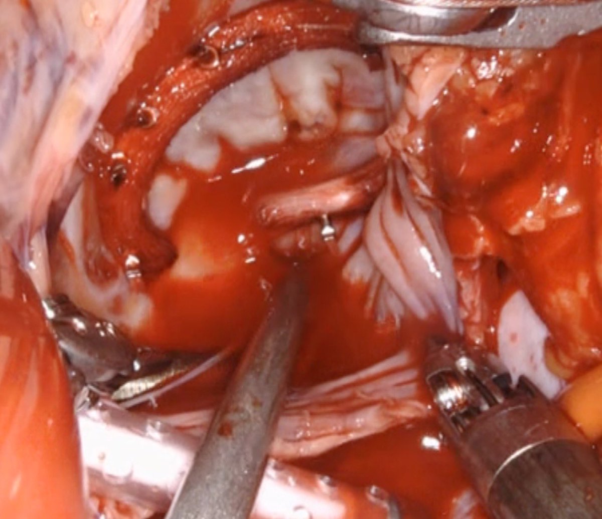 Tricuspid valve endocarditis with massive vegetation….no problem &gt;&gt; uncomplicated Robotic repair, home after 3 days… ❤️❤️❤️