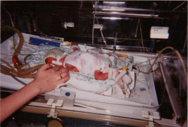 lisa_b1973's tweet photo. @BarbaraDixon__ This was our little fighter born at 29 weeks, 2nd pic was when she was a month old, shes a healthy 31 year old mummy herself now, prem babies are tough little cookies, sending love and prayers to the twins 💖💖 https://t.co/TjGt1zcwpg