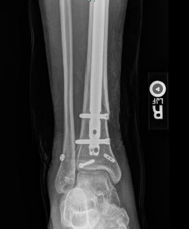 This is what I ended up doing for that case. Started with percutaneous fixation of the PM through the achilles, nailed the tibia fx, stressed the ankle, performed a finger reduction (matching the contralateral side), and fixed with a suture button.