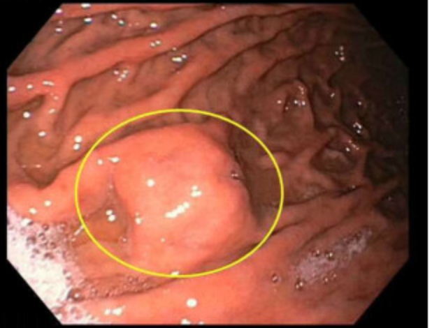 JordanBurlen's tweet photo. FTRD for glomus tumor and GIST @OvescoEndoscopy Curative endoscopic procedures @OSUWexMed
@GIPapachristou @som_krishna @HamzaWShah @EricaParkMD @APNDMD @Jskeans1 #OSUAdvancedEndoscopy https://t.co/ps0yvX5fyZ