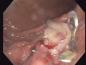 JordanBurlen's tweet photo. FTRD for glomus tumor and GIST @OvescoEndoscopy Curative endoscopic procedures @OSUWexMed
@GIPapachristou @som_krishna @HamzaWShah @EricaParkMD @APNDMD @Jskeans1 #OSUAdvancedEndoscopy https://t.co/ps0yvX5fyZ