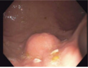 JordanBurlen's tweet photo. FTRD for glomus tumor and GIST @OvescoEndoscopy Curative endoscopic procedures @OSUWexMed
@GIPapachristou @som_krishna @HamzaWShah @EricaParkMD @APNDMD @Jskeans1 #OSUAdvancedEndoscopy https://t.co/ps0yvX5fyZ