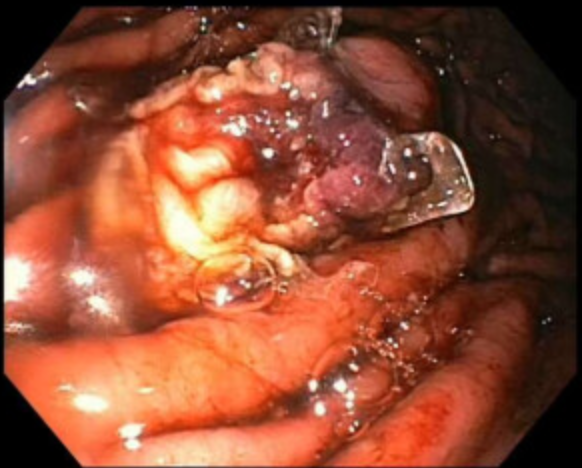 JordanBurlen's tweet photo. FTRD for glomus tumor and GIST @OvescoEndoscopy Curative endoscopic procedures @OSUWexMed
@GIPapachristou @som_krishna @HamzaWShah @EricaParkMD @APNDMD @Jskeans1 #OSUAdvancedEndoscopy https://t.co/ps0yvX5fyZ