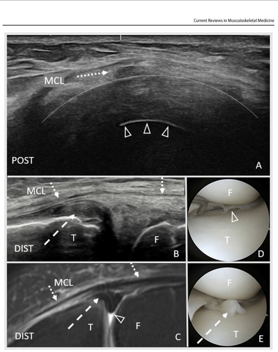 Know about #meniscus ultrasound? If not, read my latest #research on evaluation and treatment of meniscal disorders with #ultrasound , published with @SpringerNature at rdcu.be/dfFjK @mayoclinicsport @SJohnson_MD