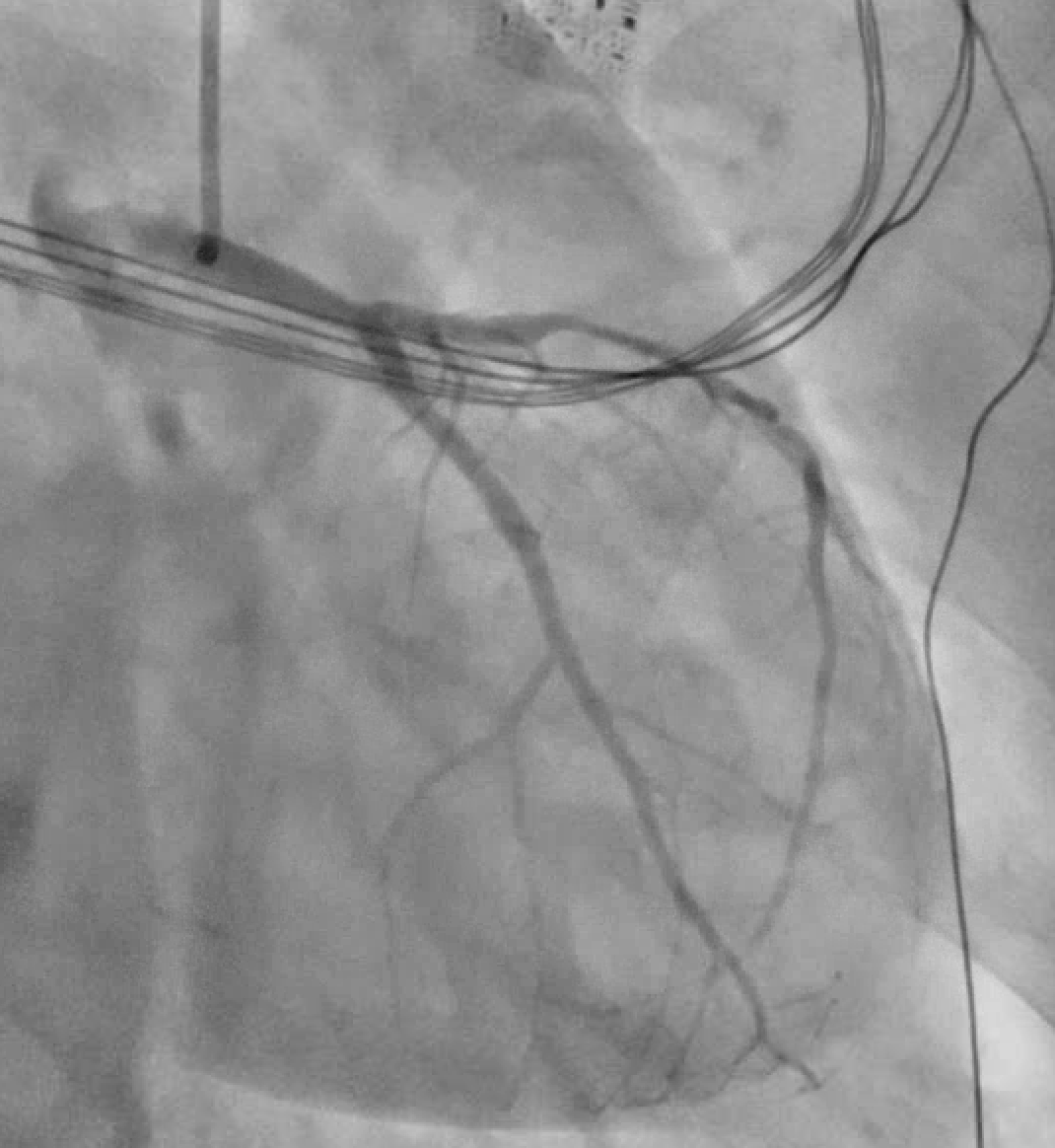 Answer: Subtle Aslanger pattern - Inferior OMI (pRCA TIMI-0) w/ diffuse LAD disease changing the infarct vector. hs-cTnT peaked at 2600 ng/L. This was an AI-guided @PMcardioApp activation; you can get access here: powerfulmedical.com/pmcardio-omi