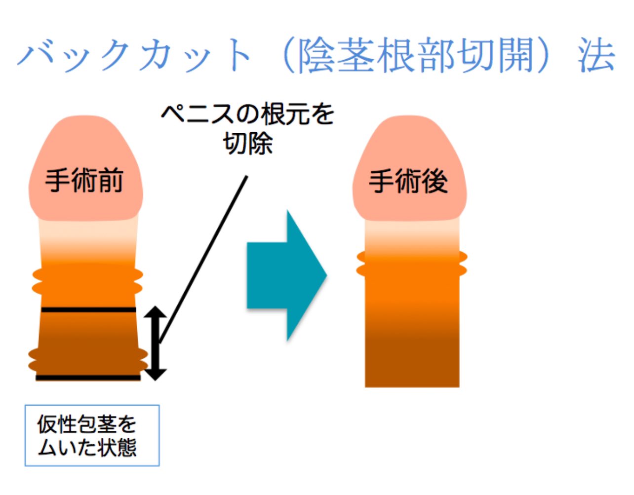 ペニスカット 