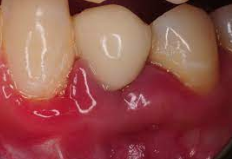 Peri-Mucositis: What Is It & How Can You Avoid It? berznerparagon.com/peri-mucositis… #perimucositis #periodontitis #gumdisease