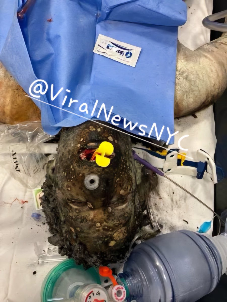 *graphic warning* Viral News NYC published this photo of the man who set himself on fire today in NYC whilst he was in an ambulance enroute to a local hospital... 👀 100% do not recommend self-immolation 🔥 #fire #selfimmolate #citylife #nyc #newyork #trump #EMT #MaxAzzarello