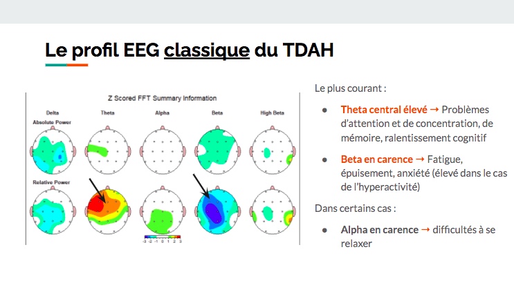 Le qEEG permet de savoir si le cerveau présente des difficultés attentionnelles ou de l'hyperactivité. Il existe de nombreux profils EEG dans le cas du TDAH mais celui ci est le plus courant. Vous souhaitez réaliser un qEEG ? Contactez nous à infos@neurofeedback-luxembourg.com