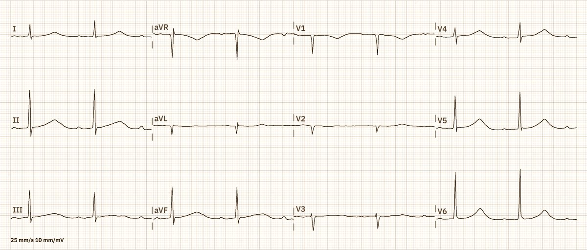 A 75-year-old woman being treated for atrial fibrillation with antiarrhythmic drugs, what do you see? What medication is likely to be on board?