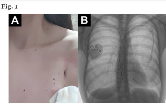 Case study of #breastfeeding woman with #mastitis and breast abscess complicated by pocket infection around her #pacemaker and then a chronic skin fistula
#IntBreastfeedJ
tinyurl.com/mr36auk6