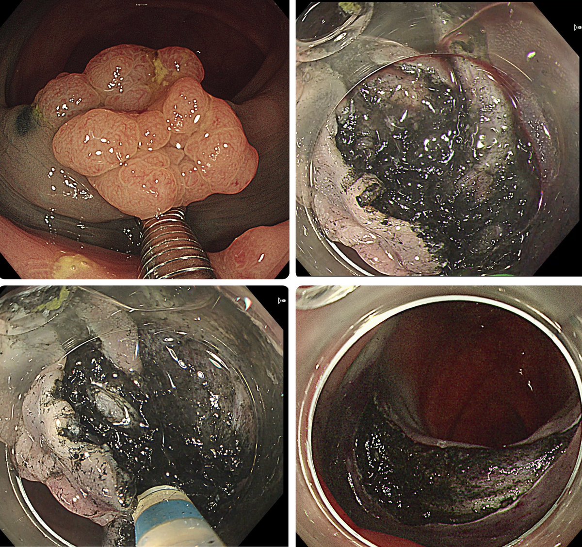 ben_sukit's tweet photo. My 111th ESD was super tough with severe submucosal fibrosis from previous tattooing under the polyp! Difficult to see the dissection plane as well. Any recommendation on this kind of lesion?

#Colochula #SurgicalEndoscopyChula #EndoscopicSubmucosalDissection #ESD #ColonPolyp https://t.co/hYnS1Q98lY