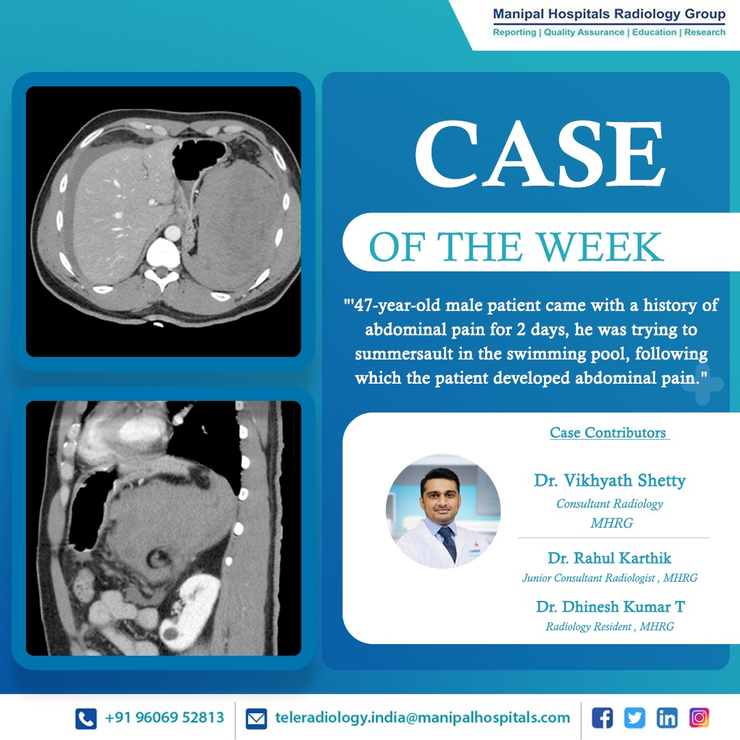 ManipalMhrg's tweet photo. Presenting our #CaseOfTheWeek - A 47-year-old male patient came with a history of abdominal pain for 2 days. History of trying summersault in the swimming pool, following which the patient developed abdominal pain.
Know More: https://t.co/cyJAz3BCzj https://t.co/vqBizHLwKx