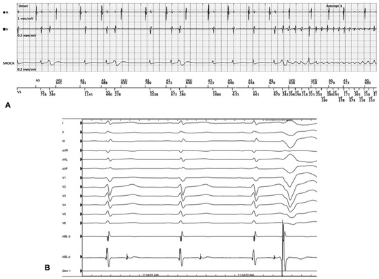 #jcdd #RecommendedPaper
Trigger and Substrate Mapping and Ablation for Ventricular Fibrillation in the Structurally Normal Heart
👉mdpi.com/2276182
@MDPIOpenAccess 
@MedPharma_MDPI