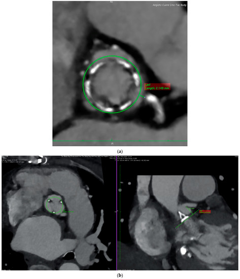 #jcdd #RecommendedPaper
Coronary Obstruction during Valve-in-Valve Transcatheter Aortic Valve Replacement: Pre-Procedural Risk Evaluation, Intra-Procedural Monitoring, and Follow-Up
👉mdpi.com/2260736
@MDPIOpenAccess 
@MedPharma_MDPI