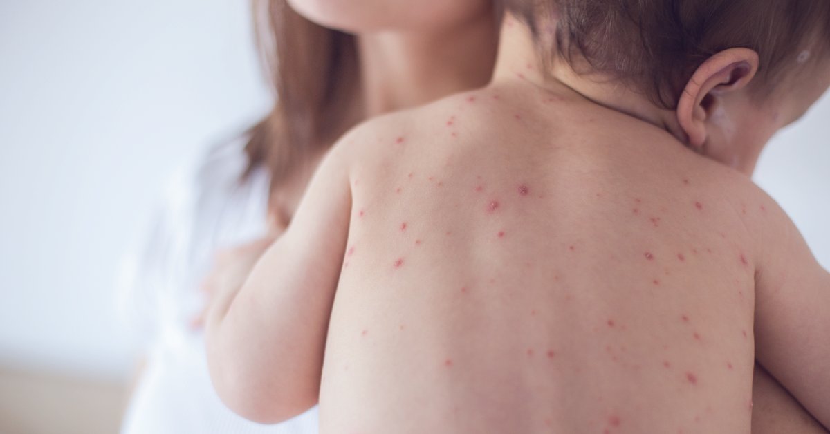 The CDC issued a warning that the vaccination rate for measles among U.S. kindergarteners has fallen below the herd immunity rate of about 95% -- and it's so contagious that 9 out of 10 unprotected people who are exposed may get sick. wb.md/4aDdRo0