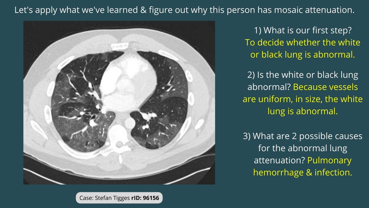 Radiopaedia's tweet photo. Is your understanding of mosaic attenuation in the lungs on CT a little hazy or patchy? 

These are just a few slides from @StefanTigges and Eugene Berkowitz's award-winning rPoster, free to view on our website at https://t.co/ZzwSKhATCA

#chestrad #FOAMrad https://t.co/QSm4OLTzl0