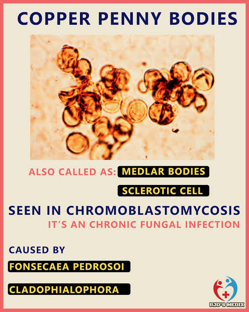 @MayoClinicINFD 'Medlar bodies' chromoblastomycosis 
Chromoblastomycosis is a chronic fungal infection of the skin & subcutaneous tissue. it usually results from a traumatic injury & inoculation of microorganism from a specific group of dematiaceous fungi(usually Fonsecaea pedrosoi,Phialophora…