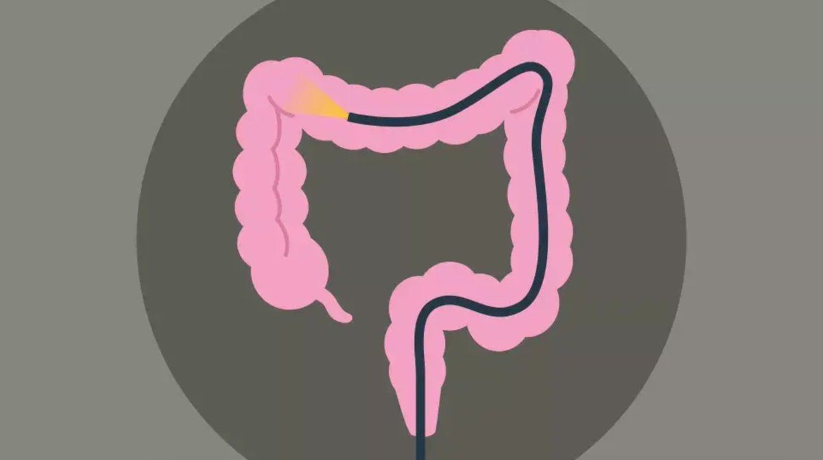 Colonoscopies are safe — and lifesaving. The chances of something going wrong during a procedure are 1 in 1000. The risk of getting colon cancer: 1 in 21.

Learn more: cle.clinic/3PZ3CSM