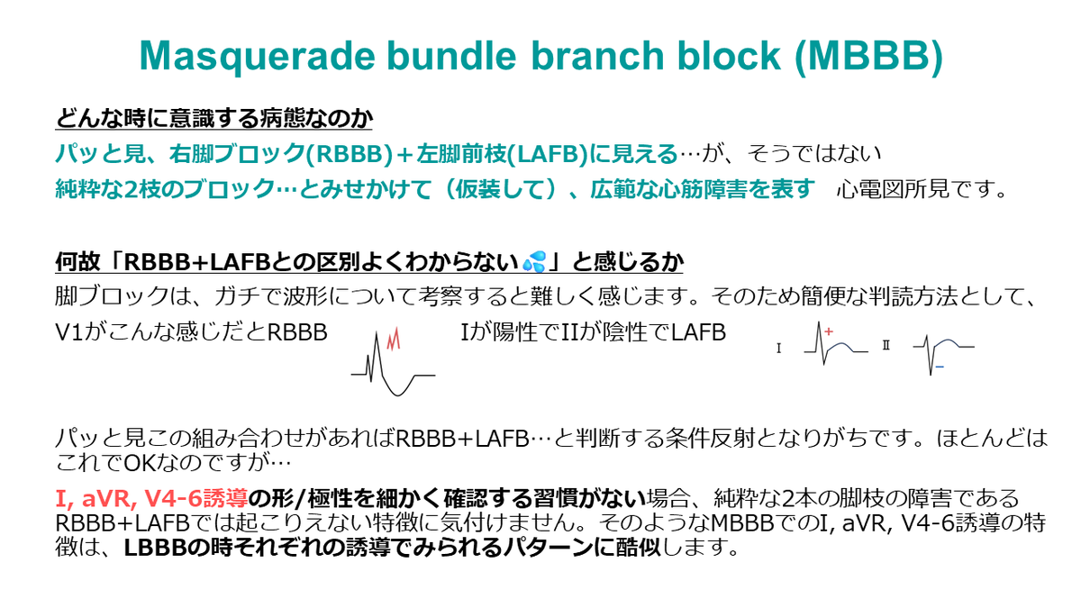 mameeps's tweet photo. 【Masquerade bundle branch block, MBBB】

2 or 3枝ブロックの鑑別として時々聞くMBBBについて理解が不十分だったので、自分なりにイメージを言語化できないかと描いてみました✍️

イメージが合っているのか、ノートを元に一緒に考えて下さったOcean先生@concealedtogezo 、ありがとうございます😭✨ https://t.co/OJ2UjyVeMu