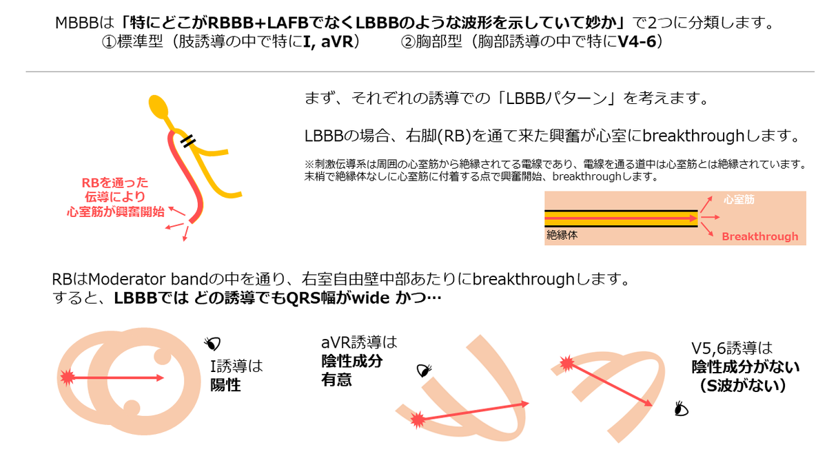 mameeps's tweet photo. 【Masquerade bundle branch block, MBBB】

2 or 3枝ブロックの鑑別として時々聞くMBBBについて理解が不十分だったので、自分なりにイメージを言語化できないかと描いてみました✍️

イメージが合っているのか、ノートを元に一緒に考えて下さったOcean先生@concealedtogezo 、ありがとうございます😭✨ https://t.co/OJ2UjyVeMu