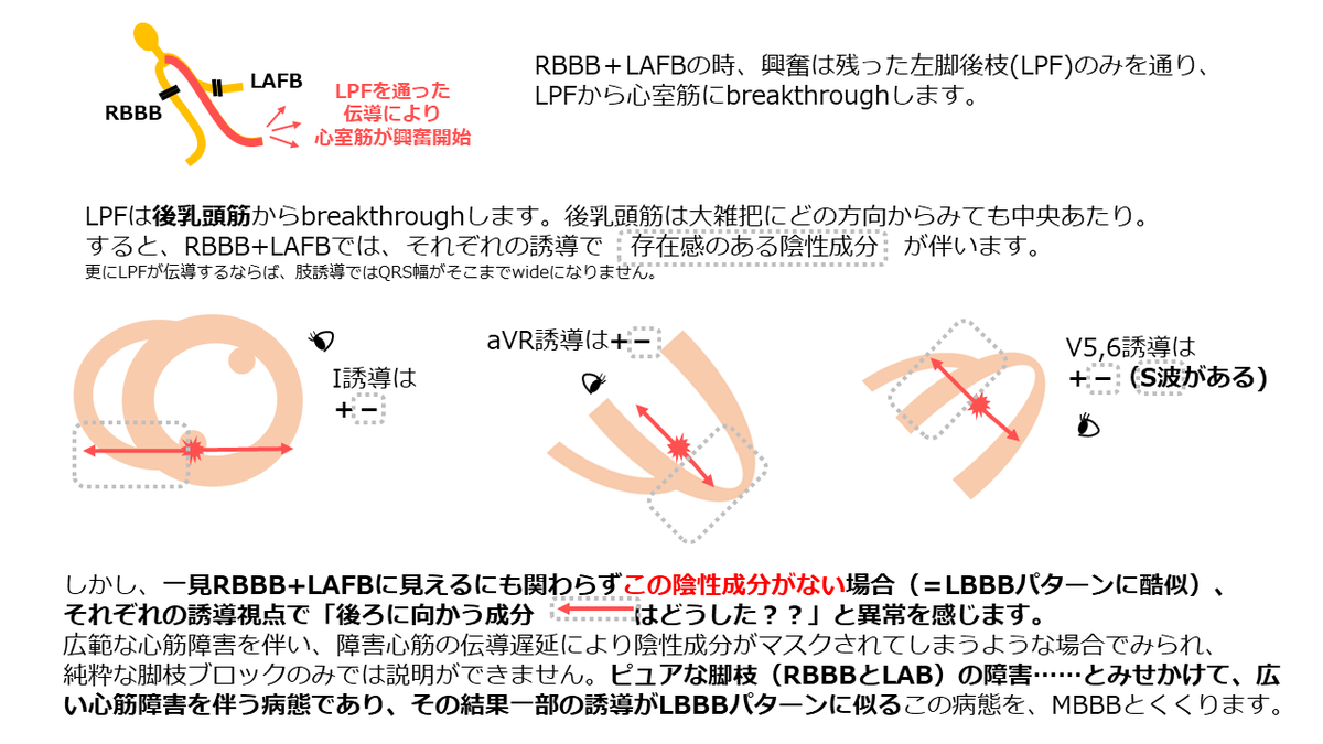 mameeps's tweet photo. 【Masquerade bundle branch block, MBBB】

2 or 3枝ブロックの鑑別として時々聞くMBBBについて理解が不十分だったので、自分なりにイメージを言語化できないかと描いてみました✍️

イメージが合っているのか、ノートを元に一緒に考えて下さったOcean先生@concealedtogezo 、ありがとうございます😭✨ https://t.co/OJ2UjyVeMu
