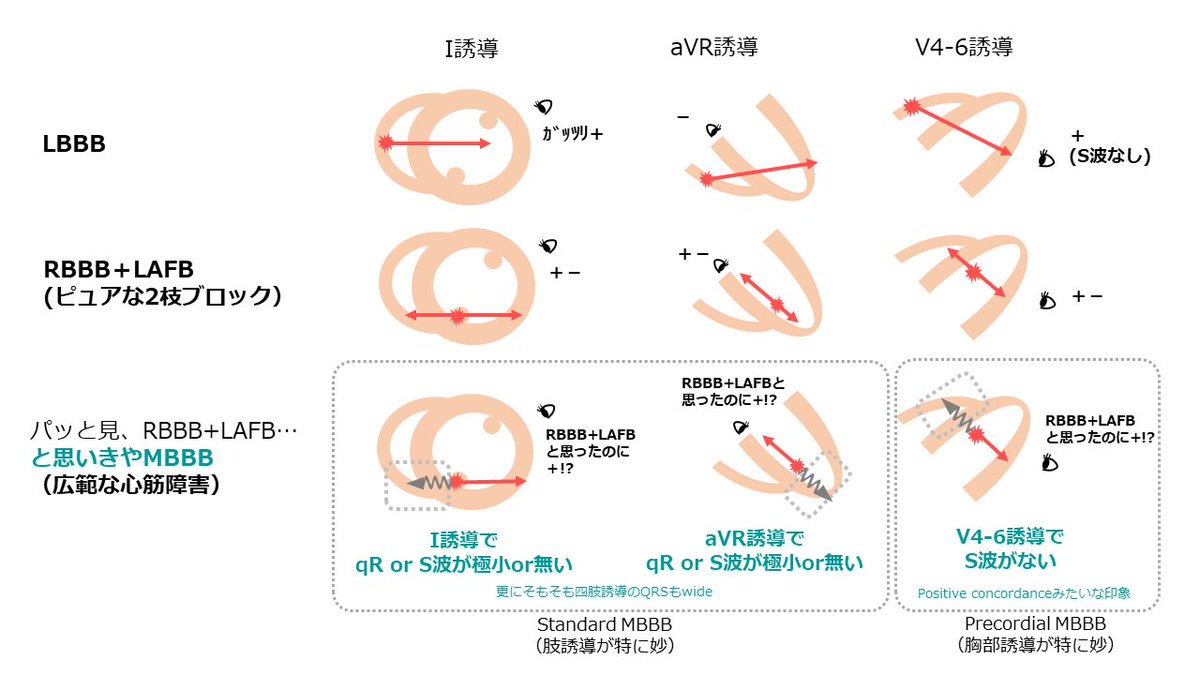 mameeps's tweet photo. 【Masquerade bundle branch block, MBBB】

2 or 3枝ブロックの鑑別として時々聞くMBBBについて理解が不十分だったので、自分なりにイメージを言語化できないかと描いてみました✍️

イメージが合っているのか、ノートを元に一緒に考えて下さったOcean先生@concealedtogezo 、ありがとうございます😭✨ https://t.co/OJ2UjyVeMu