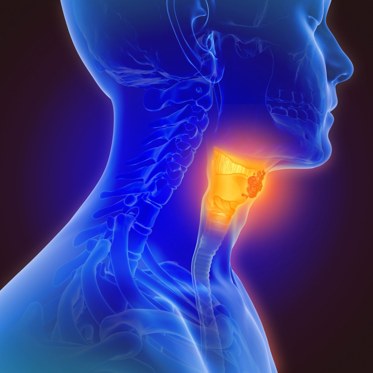 Learn more about preventing oral cancers. Drinking alcohol and excess body fatness are risk factor for these cancers. There's also limited suggestive evidence that non-starchy vegetables, a healthy dietary pattern and drinking coffee lower the risk. bit.ly/3KHdhLH