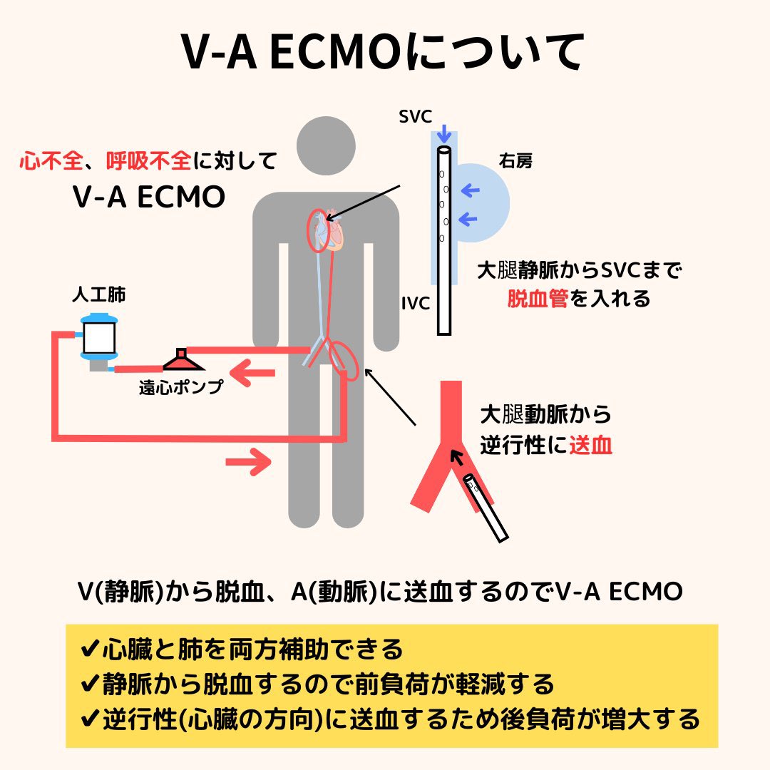 本日は【ECMO】です。 ECMOの種類を図解しています。 ・V-AV ECMOって何？ ・V-VとV-Aとかよくわかんない  って人は是非見てください。 新人Ns.やCEさん、勉強会の資料などに使って頂ければと思います。 参考になったらいいね、リツイートお願いします🙇‍♂️  ＃臨床工学 ...