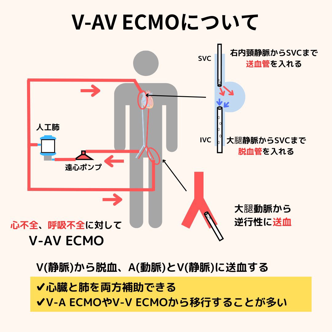 本日は【ECMO】です。 ECMOの種類を図解しています。 ・V-AV ECMOって何？ ・V-VとV-Aとかよくわかんない  って人は是非見てください。 新人Ns.やCEさん、勉強会の資料などに使って頂ければと思います。 参考になったらいいね、リツイートお願いします🙇‍♂️  ＃臨床工学 ...