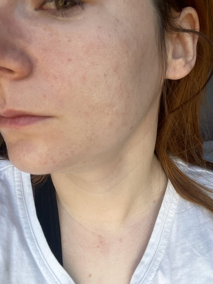 HELP!
I cannot wear any foundation without it tinted my skin (aka the white patches and then random redness). I’ve recently tried bareminerals pro, but it’s a no go.

Anyone who uses hypoallergenic products can recommend a makeup brand line with good quality products 🙏🏻