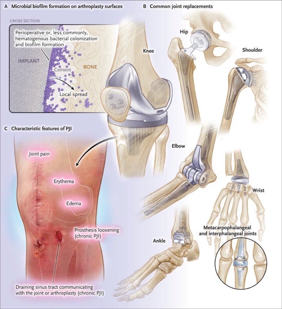 Common human body joint replacements and prosthetic joint infection as a common complication A. microbial formation on the surface of prosthesis B. common joint replacements C. external appearance of prosthetic joint infection #arthroplasty #joint nejm.org/doi/full/10.10…