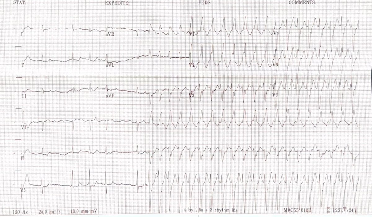 SVT with aberrancy or VT? #EPeeps